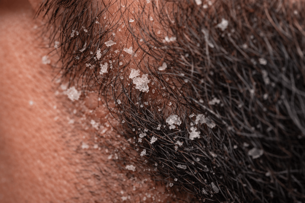 How to Get Rid of Beard Dandruff